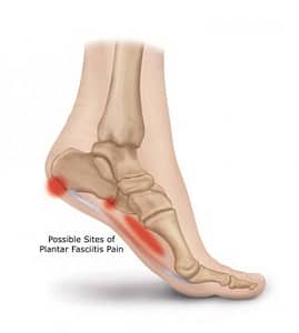 How long to wear a walking boot for plantar Fasciitis2